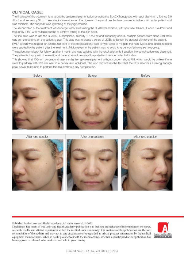 1064 nm Picosecond Laser for Treatment of Epidermal Pigmentation