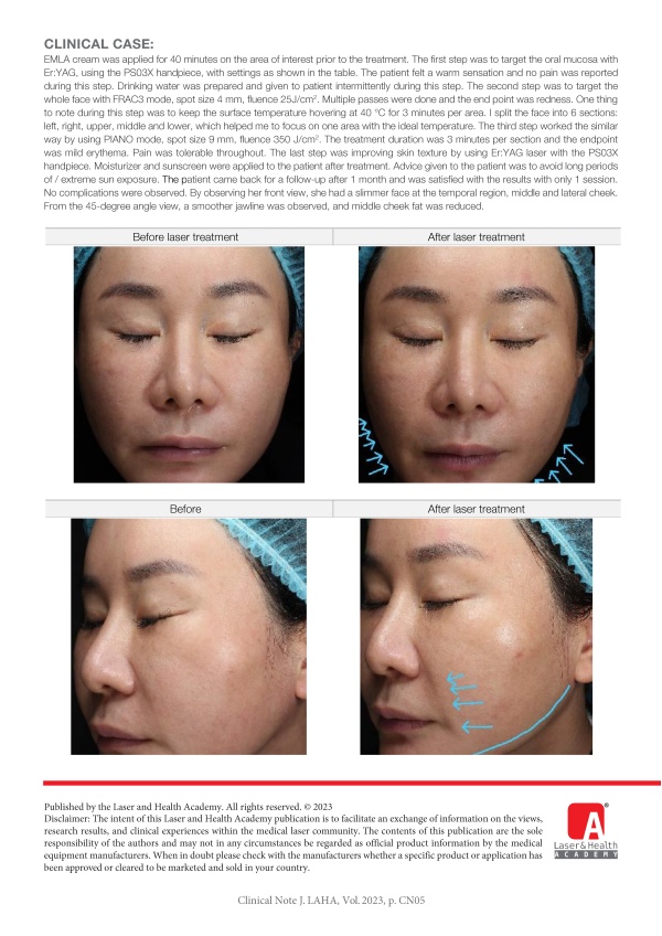 Correcting Overfilled Fat Grafting with Combination of Nd:YAG and Er:YAG Laser