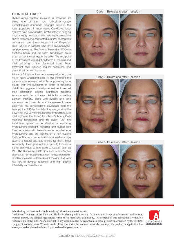 Hydroquinone-resistant Melasma Management with StarWalker PQX on an Asian patient