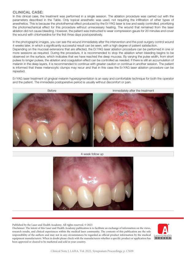 Smile Improvement: Aesthetic Treatment of Gingival Melanin Hyperpigmentation with Er:YAG Laser