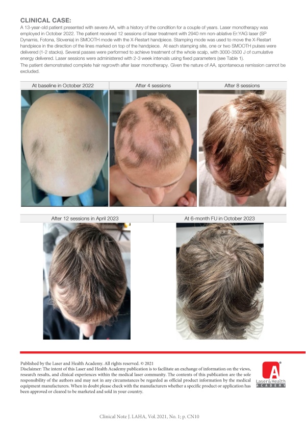 Non-Ablative Er:YAG Laser Monotherapy for Alopecia Areata using X-Restart Handpiece