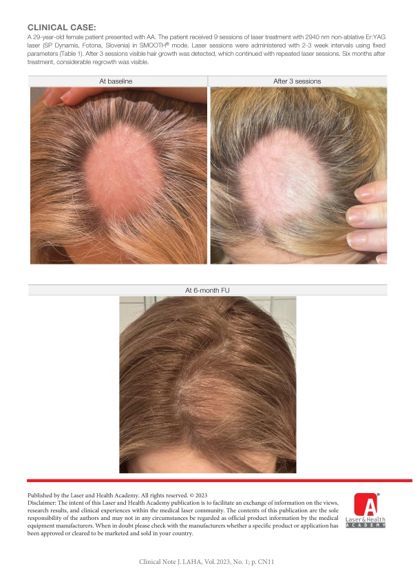 Management of Alopecia Areata with HAIRestart®