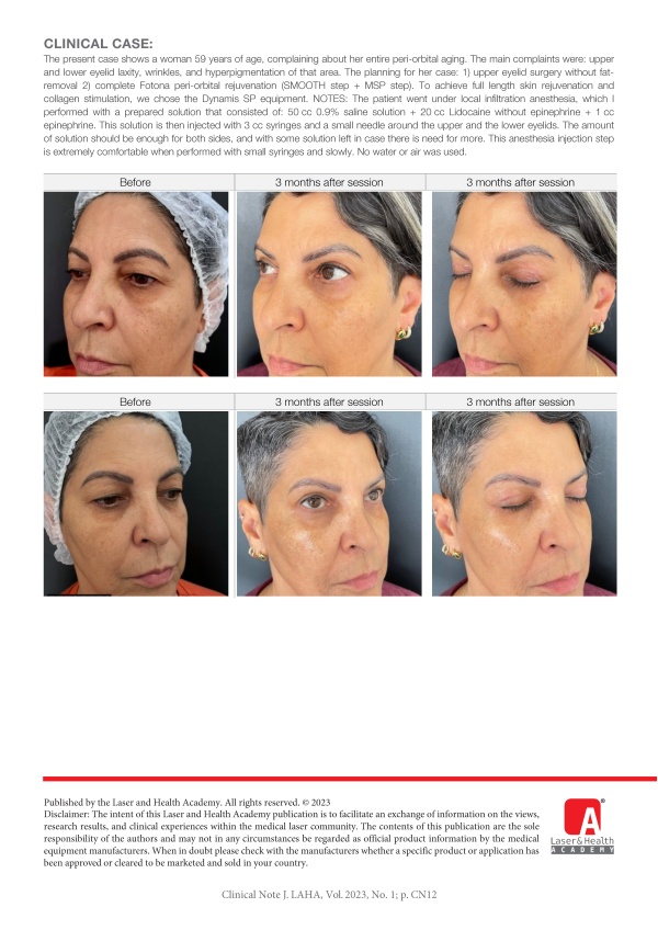 Complete Peri-orbital Rejuvenation with Fotona SMOOTH®