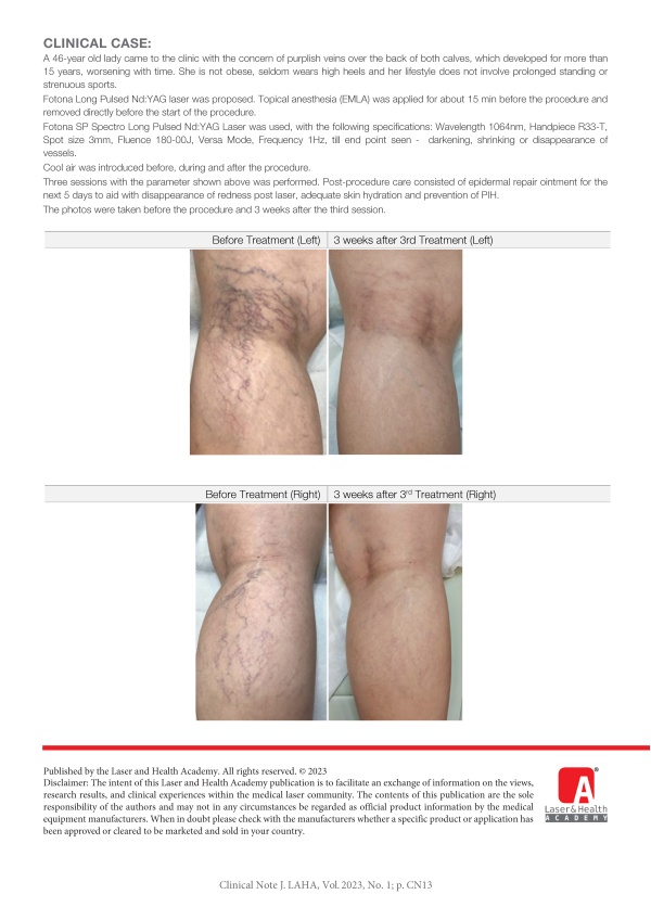 Laser Treatment for Leg Telangiectasias