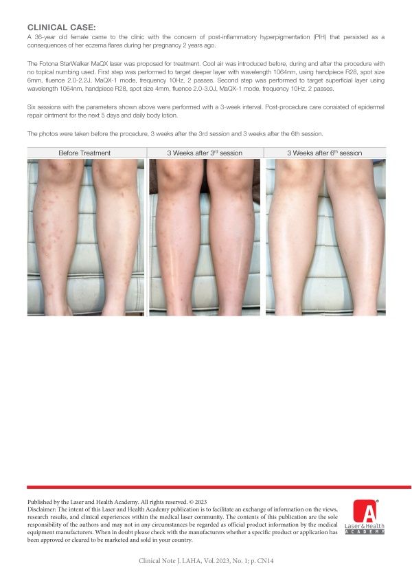 Management of Post-Inflammatory Hyperpigmentation on Legs with Nd:YAG laser