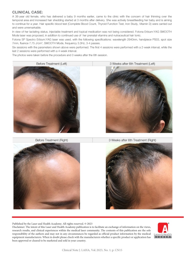 Management of Post-Partum Telogen Effluvium (PPTE) With Laser