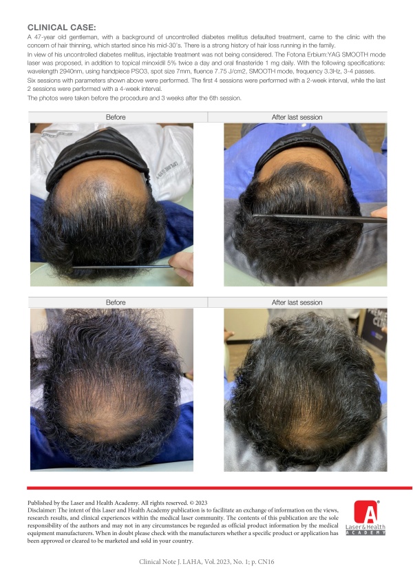Non-Injectible Treatment Option for Androgenetic Alopecia