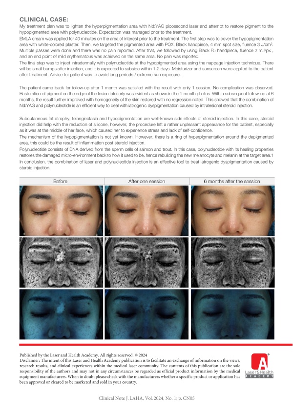 Treatment of Triamcinolone-Induced Skin Dyspigmentation with Nd:YAG Picosecond Laser with Combination of Polynucleotide