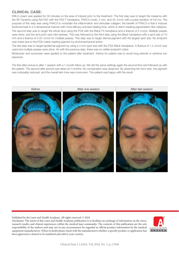 Combination of Picosecond and Long-Pulse Nd:YAG for Melasma Treatment
