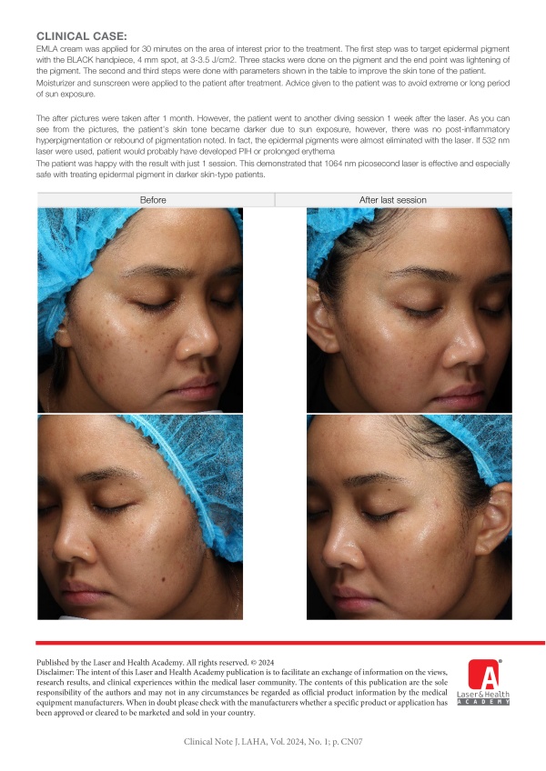 Effective and Safe Ephelides Treatment for Darker Skin Type with PQX 1064 nm