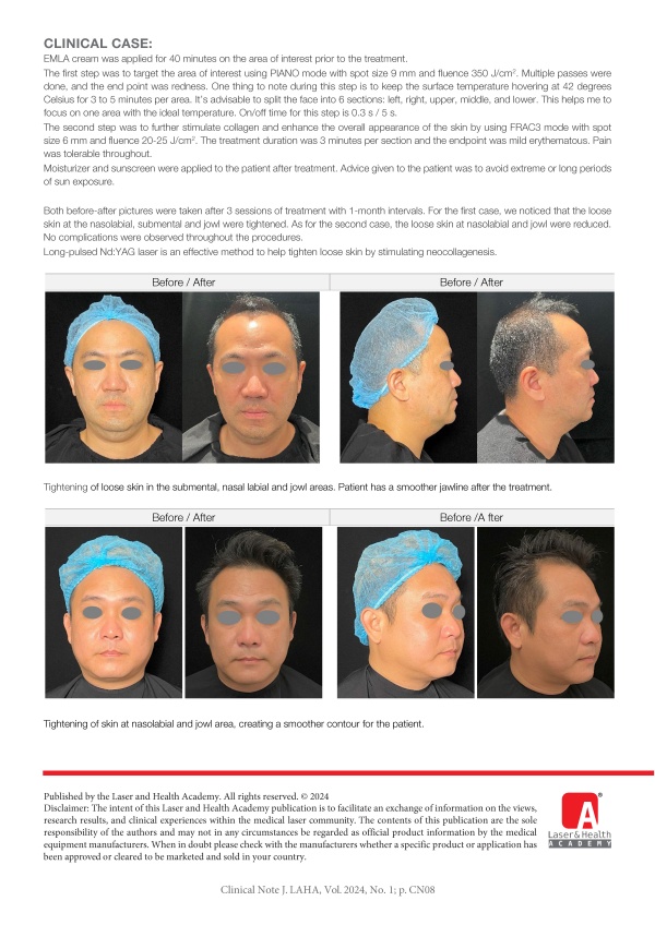 Skin Tightening with Long-Pulsed Nd:YAG Laser