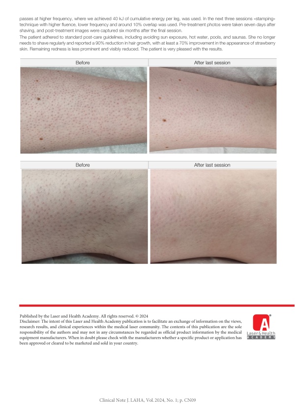 Laser Hair Removal Reduction of 