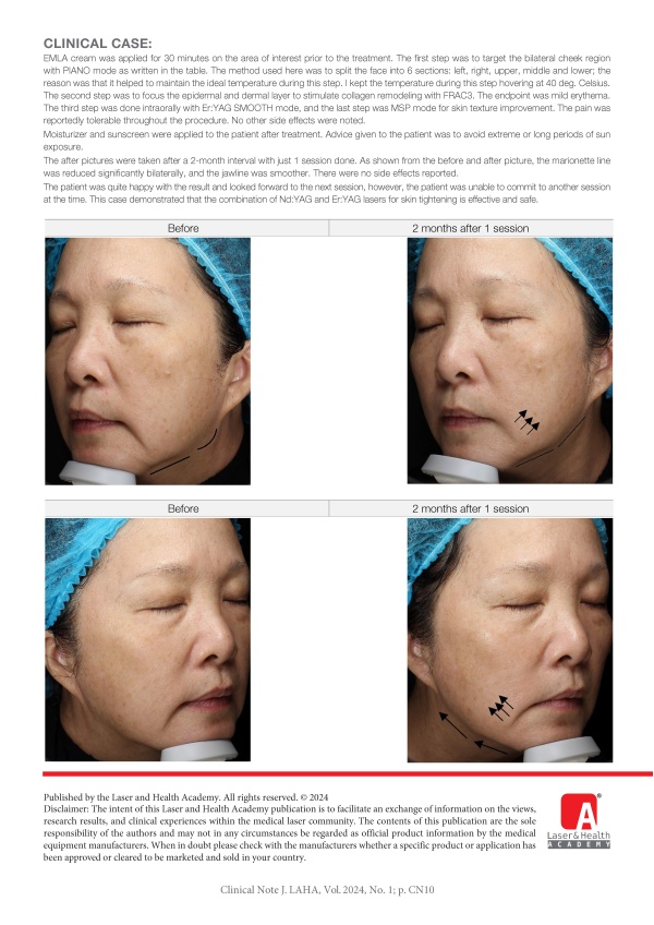 Facial Tightening with Combination of Nd:YAG and Er:YAG Lasers