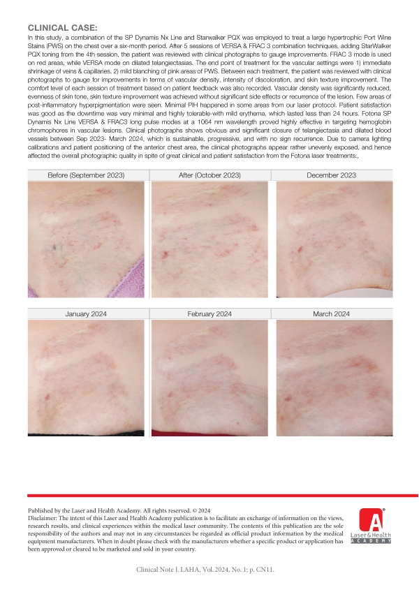 Hypertrophic port wine stain management with combination of SP Dynamis Nx Line with DMC Cool Mist & StarWalker PQX on Asian skin
