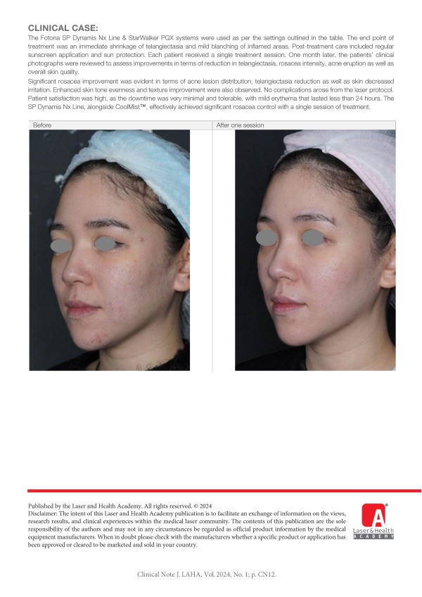 Rosacea & Telangiectasia Protocol for Asian and Darker Skin using SP Dynamis® Nx Line & StarWalker® PQX