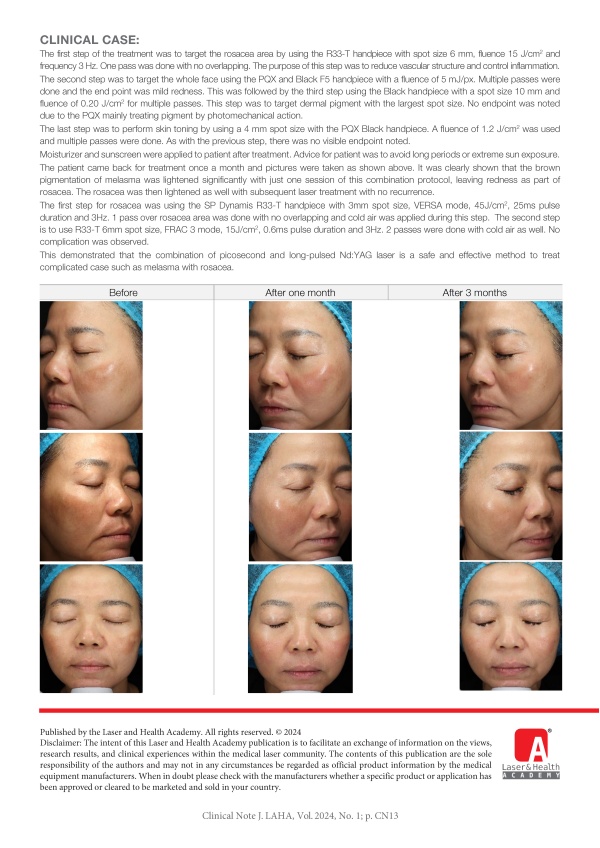 Facial Tightening with Combination of Nd:YAG and Er:YAG Lasers
