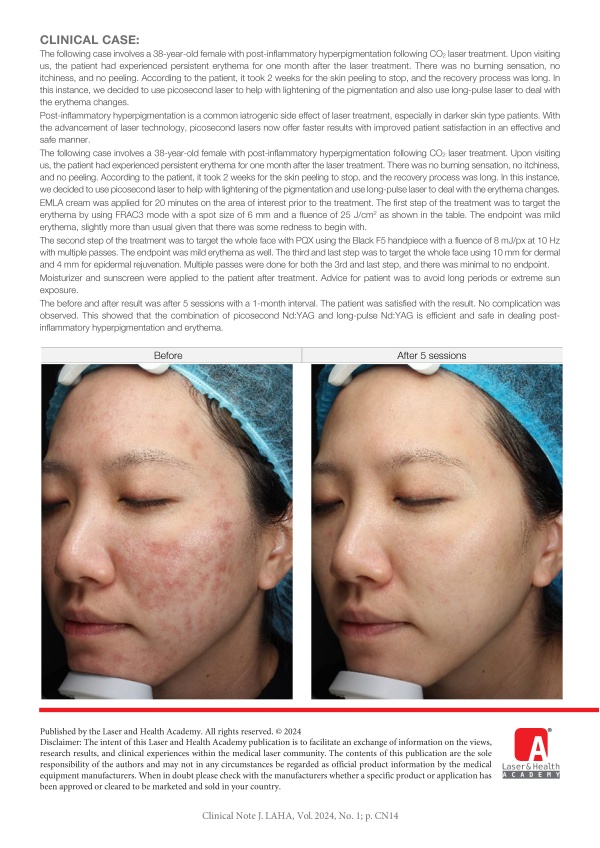 Treatment of Iatrogenic PIH Case with Picosecond Nd:YAG and Long-Pulse Nd:YAG: a Case Report