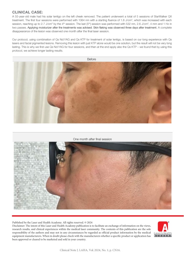 Solar Lentigo Removal