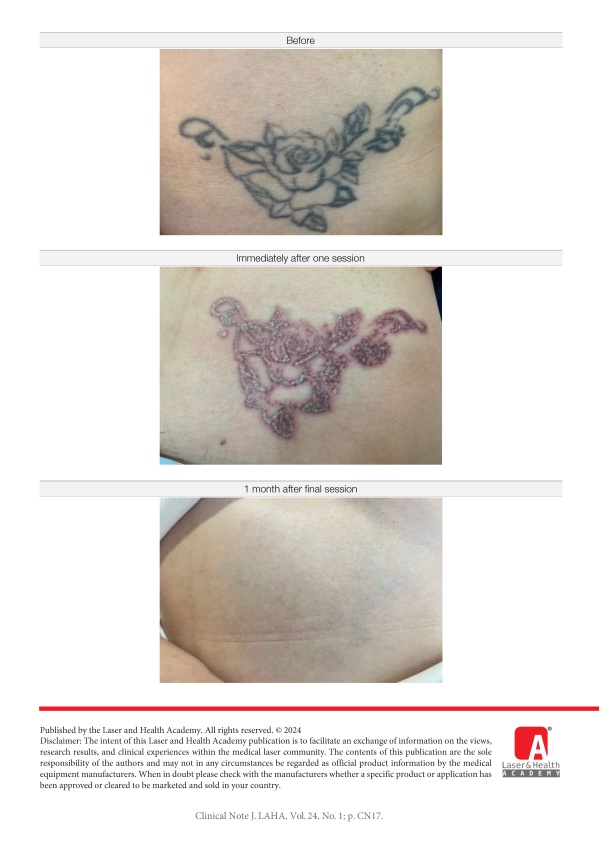 Tattoo Removal