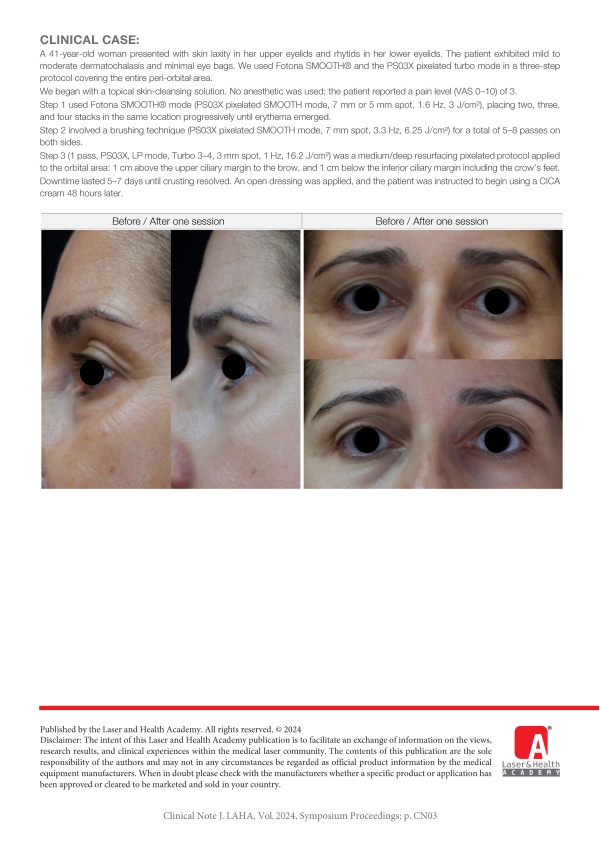 Advanced SmoothEye® Protocol – Using PS03X Turbo Mode