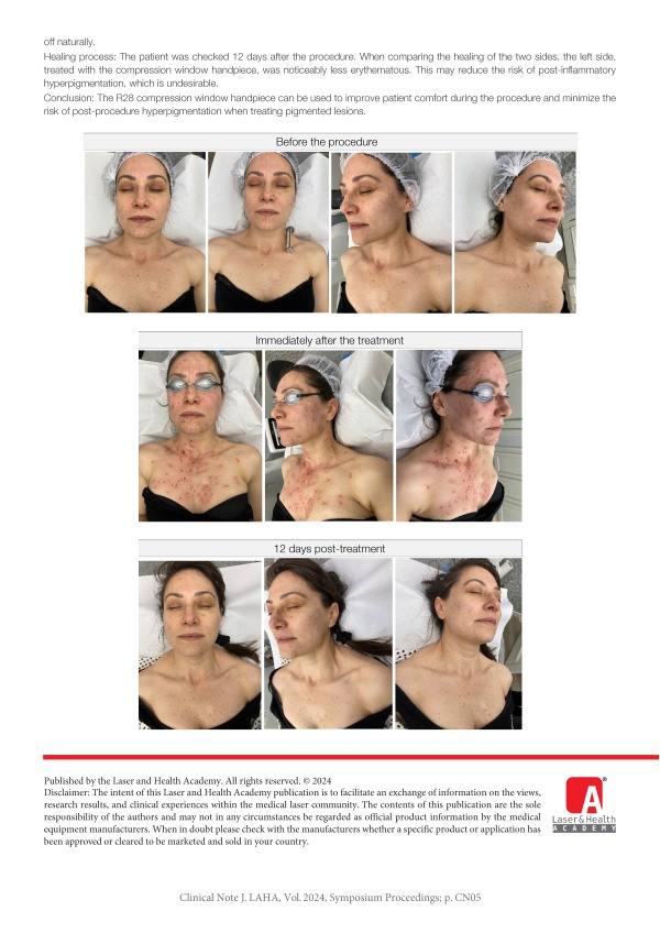 Benefits of Diacope Handpiece in StarWalker MaQX