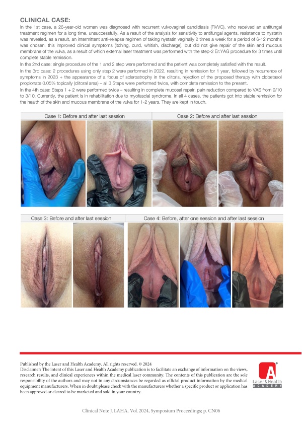 Combination of Er: and Nd:YAG in Treatment of Vulvodynia and Dermatoses of the Vulva