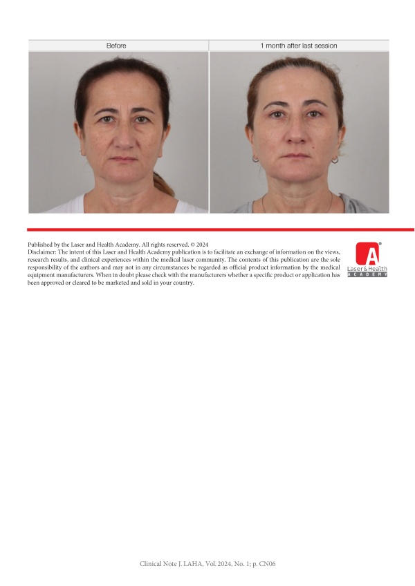 Combined Laser Treatments after Surgical Thread Lift Operations