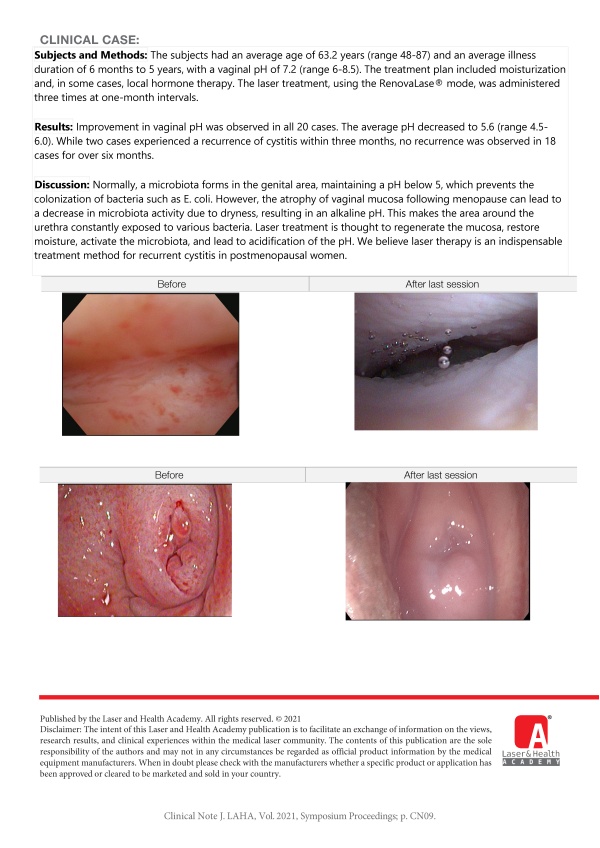 Effects of Laser Therapy on Recurrent Cystitis