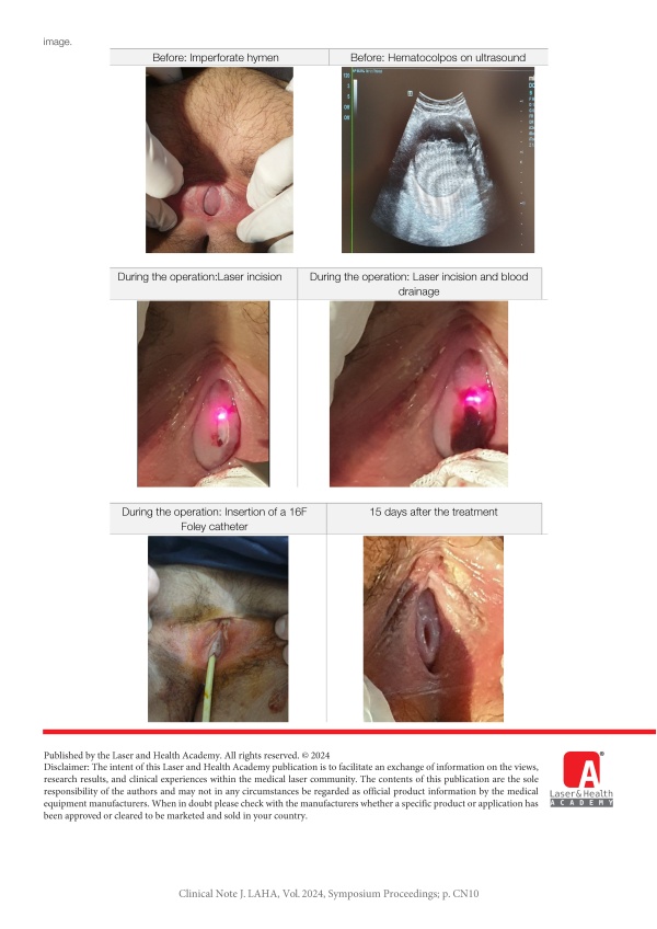 Imperforate Hymen Treatment by 2940nm Fotona Er:YAG Laser