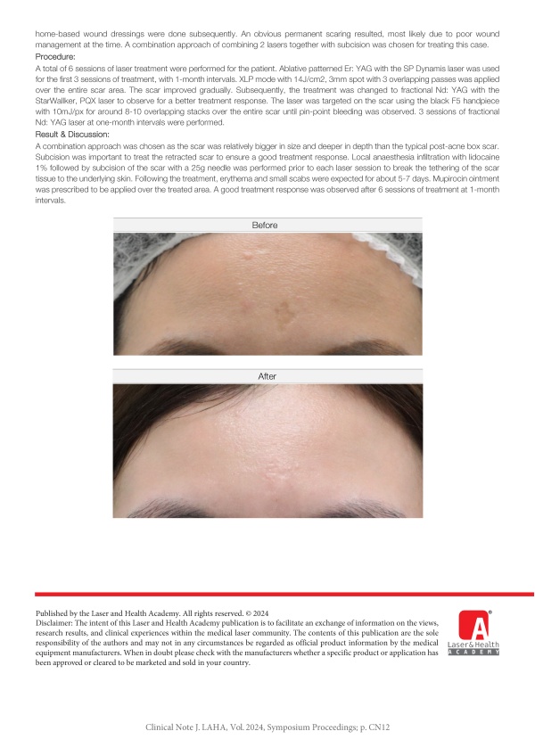 Combination Of Ablative Er:YAG Laser and Fractional Picosecond Nd:YAG Laser In Treating a Traumatic Childhood Scar