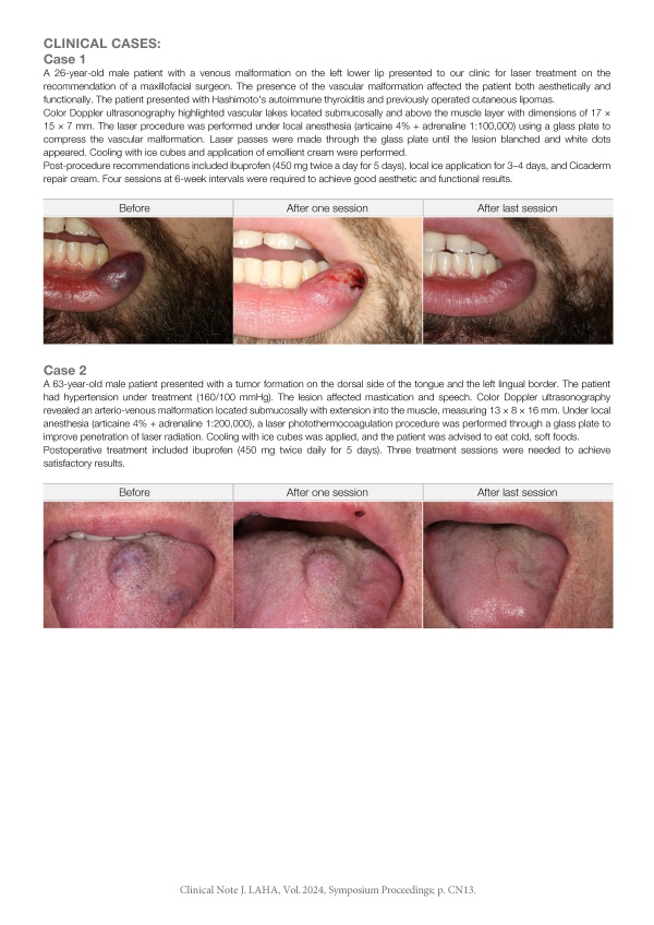LightWalker Laser Treatment of Vascular Malformations in the Oral Area