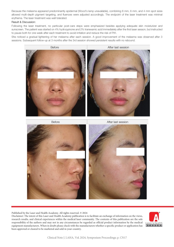 Picosecond 1064 nm Nd:YAG Laser Treatment for Melasma in an Asian Female