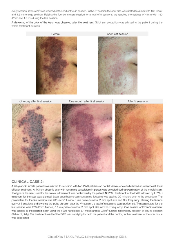 Short-Pulse Nd:YAG Treatment for Port-Wine Stain