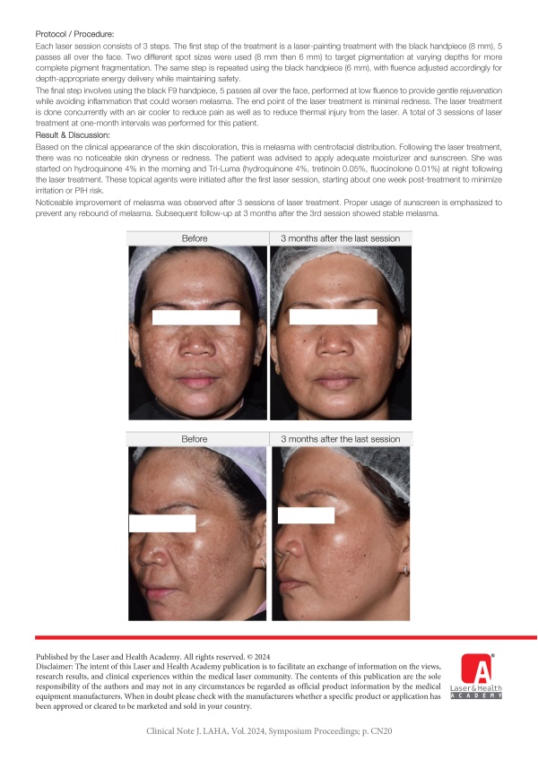 Treatment of centrofacial melasma with picosecond Nd:YAG 1064nm laser in Fitzpatrick skin type IV patient