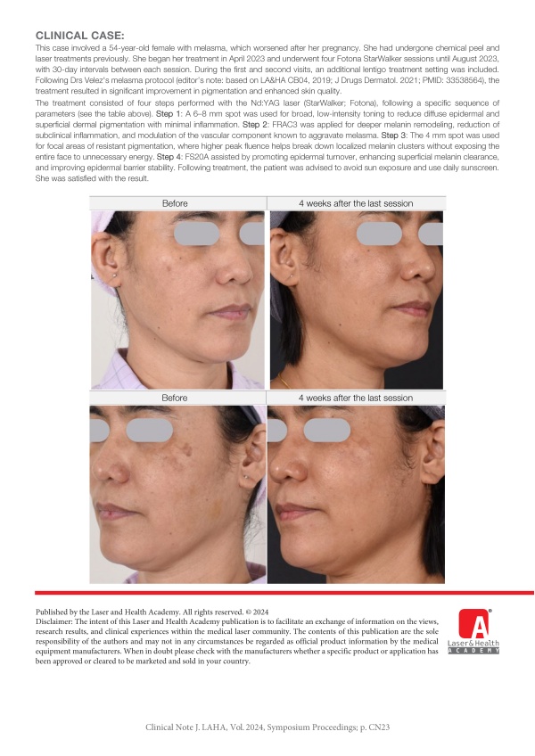 Melasma and Solar Lentigo in Asian Skin (Skin Type IV) with Fotona StarWalker