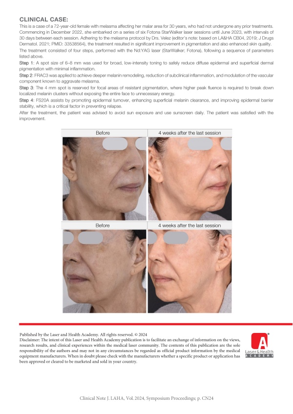 Treatment of Melasma in Asian Skin with Fotona StarWalker