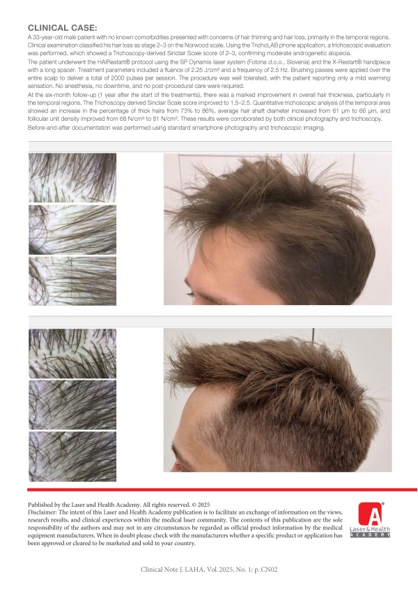 Treatment of Male Pattern Hair Loss and Hair Thinning with HAIRestart®