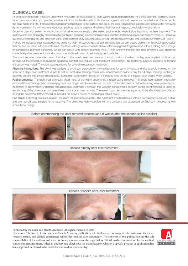 Combined Saline and Laser Eyebrow Tattoo Removal