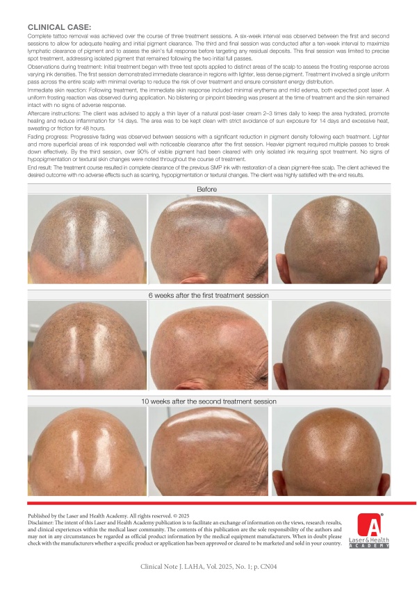 Scalp Micro Pigmentation (SMP) Tattoo Removal