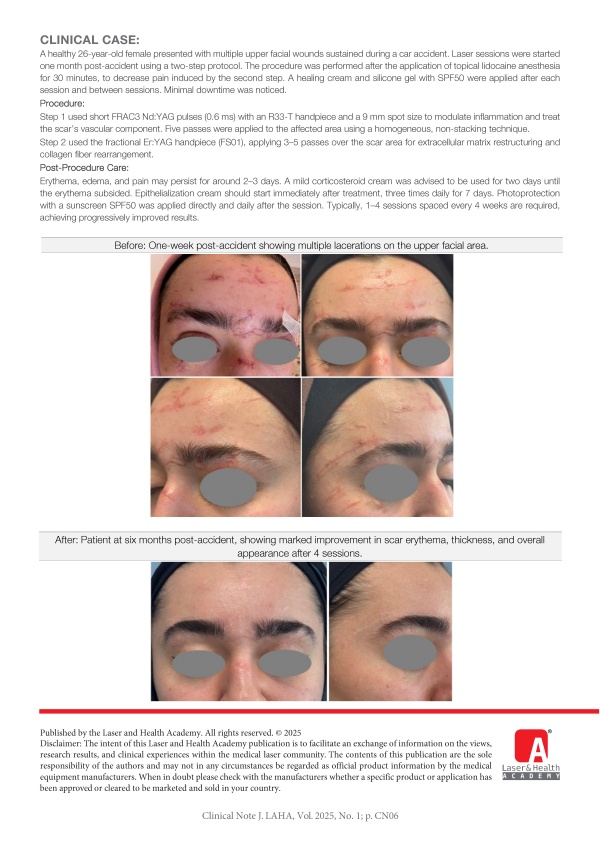 Treatment of Facial Scars Combining Er:YAG and Nd:YAG using the SP Dynamis Laser