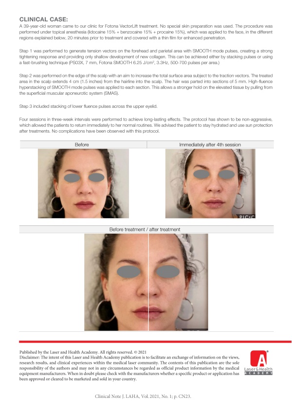 Er:YAG Treatment for Eyebrow Tail Elevation and Eyelid Rejuvenation using the Fotona VectorLift Technique with SMOOTH Mode Hyperstacking