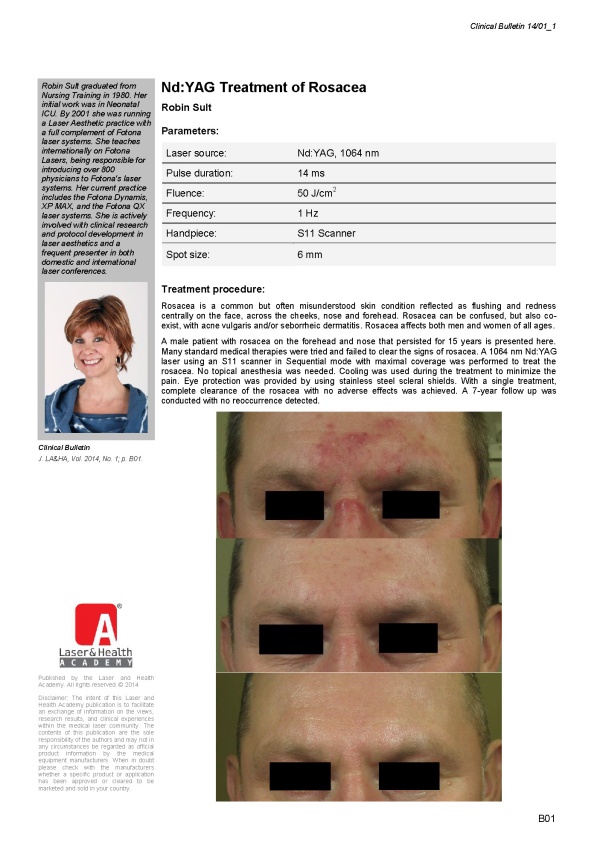 Nd:YAG Treatment of Rosacea