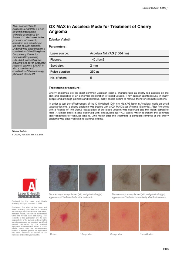 QX MAX in Accelera Mode for Treatment of Cherry Angioma