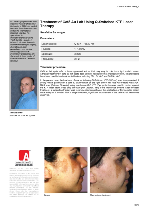 Treatment of Café Au Lait Using Q-Switched KTP Laser Therapy