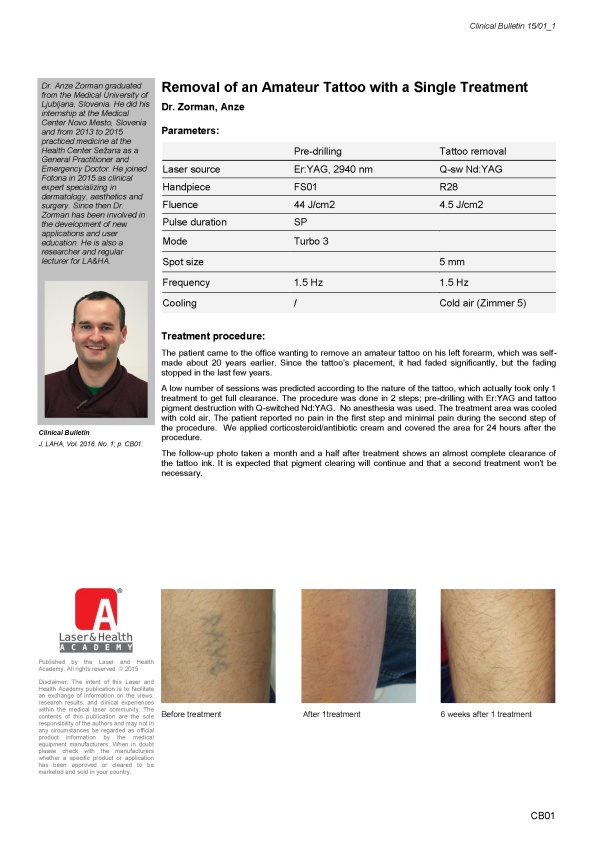 Removal of an Amateur Tattoo with a Single Treatment