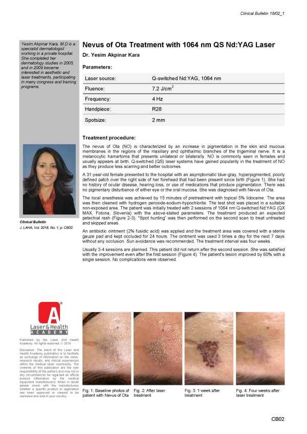 Nevus of Ota Treatment with 1064 nm QS Nd:YAG Laser