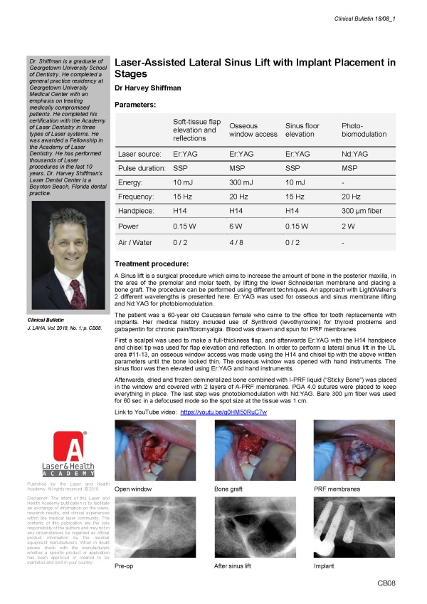 Laser-Assisted Lateral Sinus Lift with Implant Placement in Stages