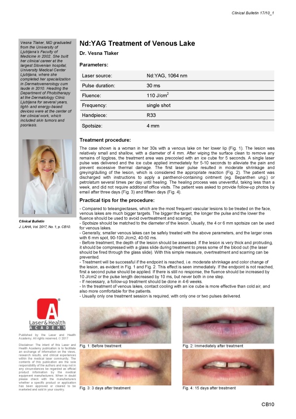 Nd:YAG Treatment of Venous Lake