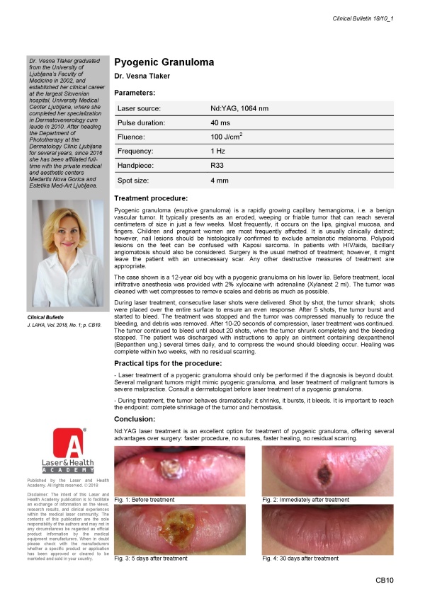 Pyogenic Granuloma