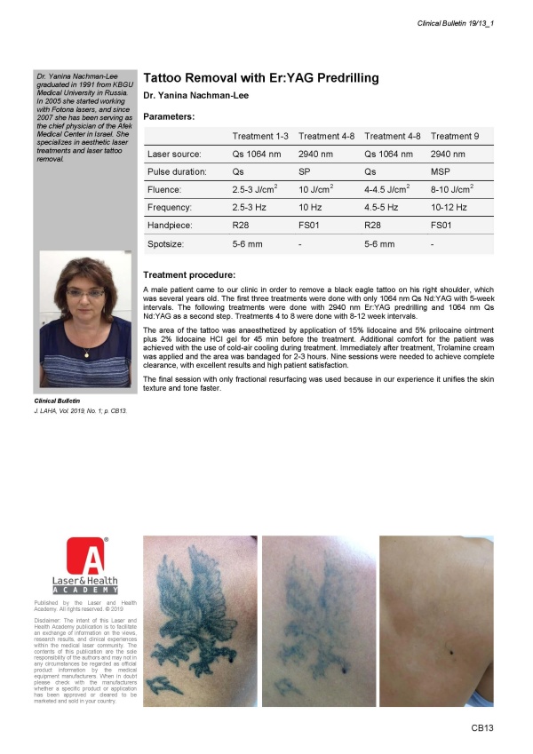Tattoo Removal with Er:YAG Predrilling